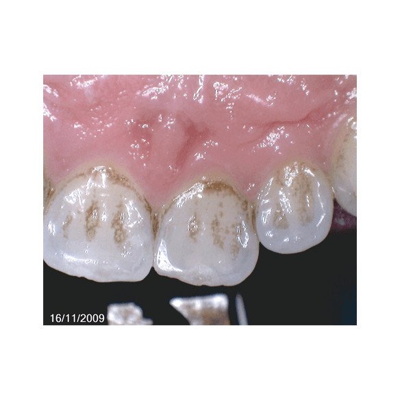 OwandyCam HD caméra intra-orale numérique USB Owandy