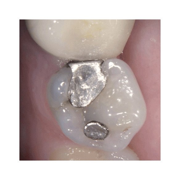 Caméra intra-orale CS 1200 Carestream