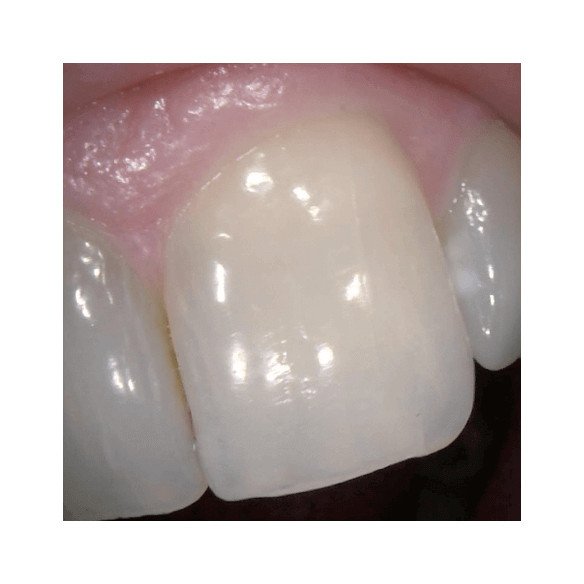 Caméra intra-orale CS 1200 Carestream