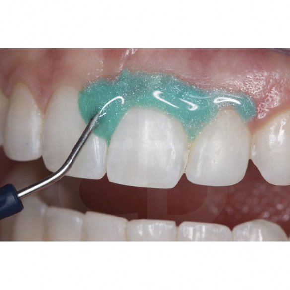 Kit OpalDam Ultradent